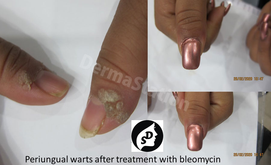 Periungual Warts after treatment with Bleomycin