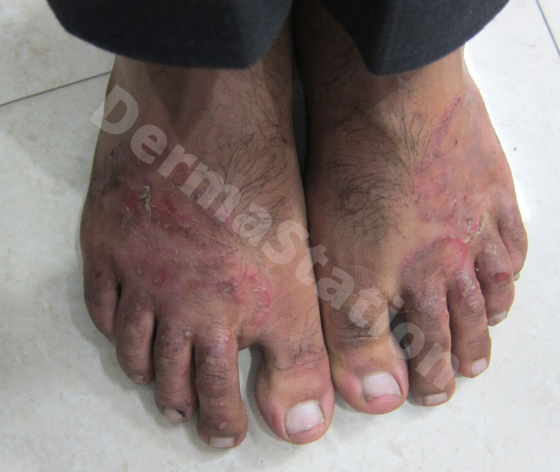 fungal infection treatment in janakpuri, Dermatologist In Janakpuri