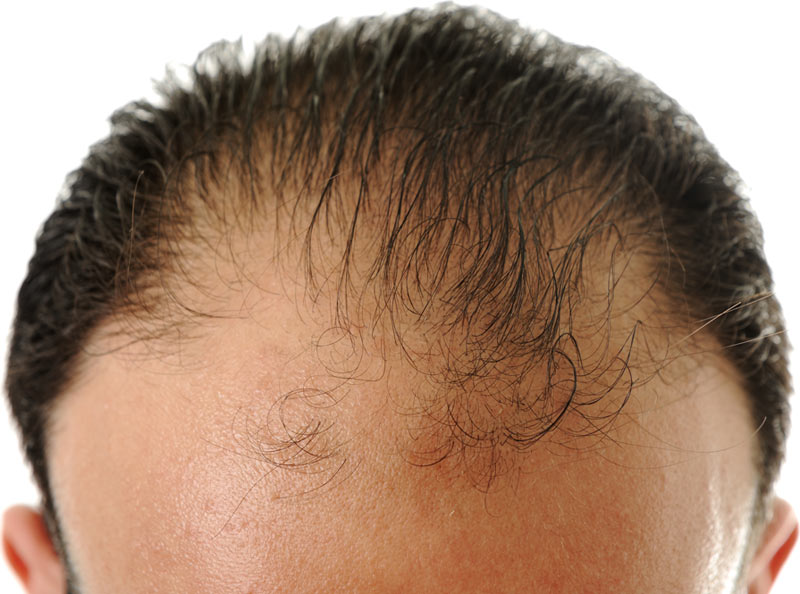 Male Pattern Hair Loss (Androgenetic Alopecia)