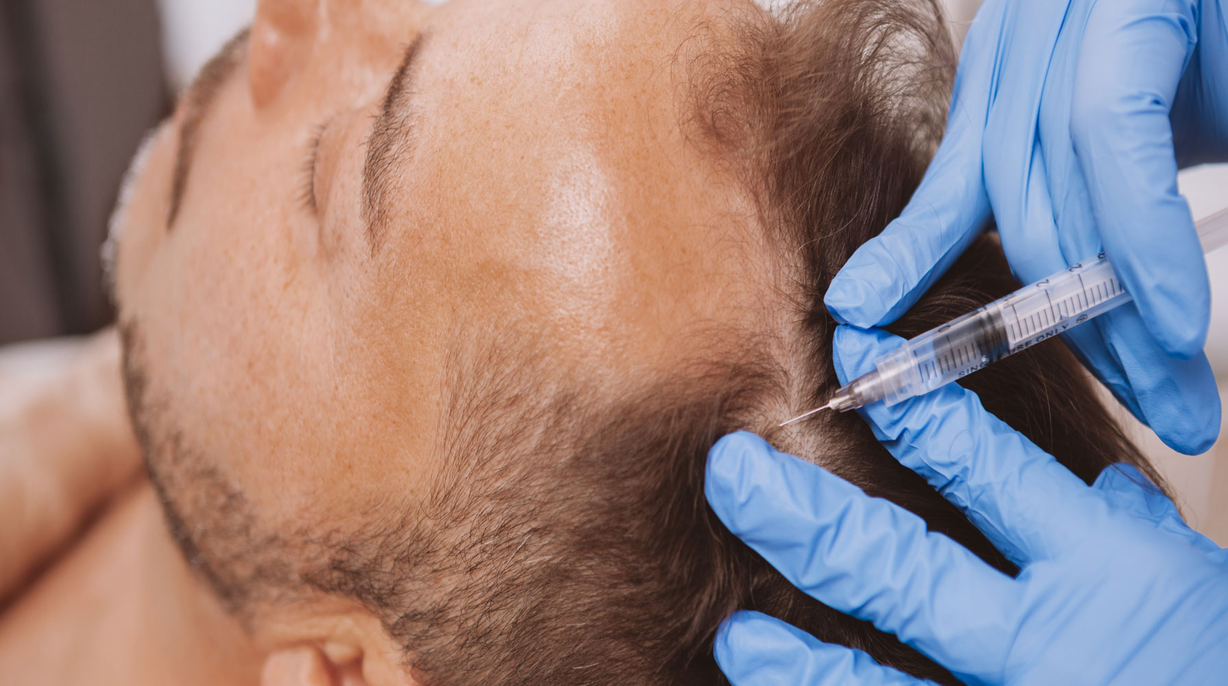 FOLLIRICH: AUTOLOGOUS GFC THERAPY FOR HAIR LOSS