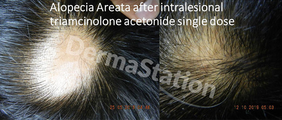 Alopecia Areata After intralesional triamcinolone acetonide single dose