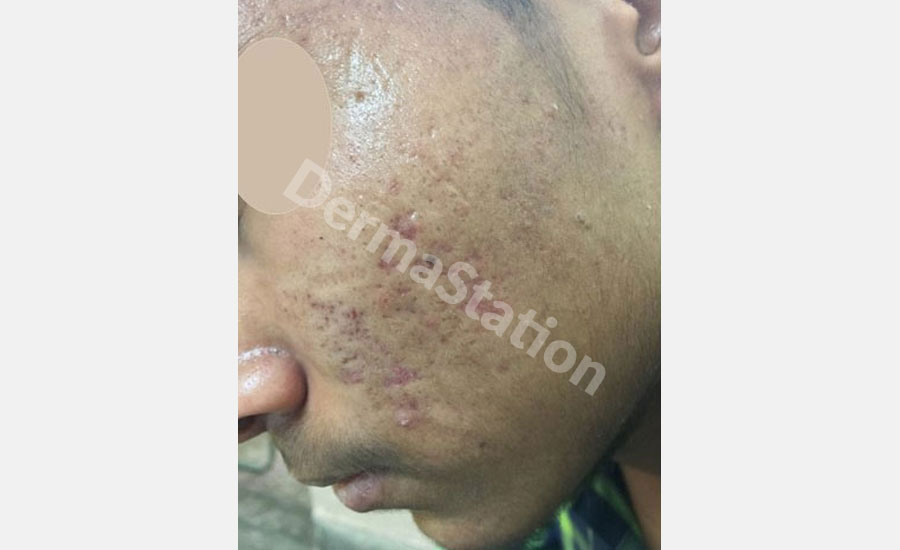 acne scars face