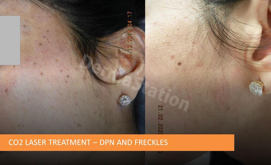 CO2 Laser Treatment - DPN and FRECKLES