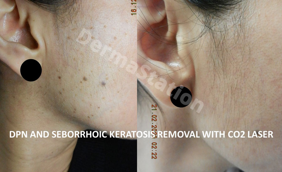 DPN and Seborrhoic Keratosis Removal With Co2 Laser