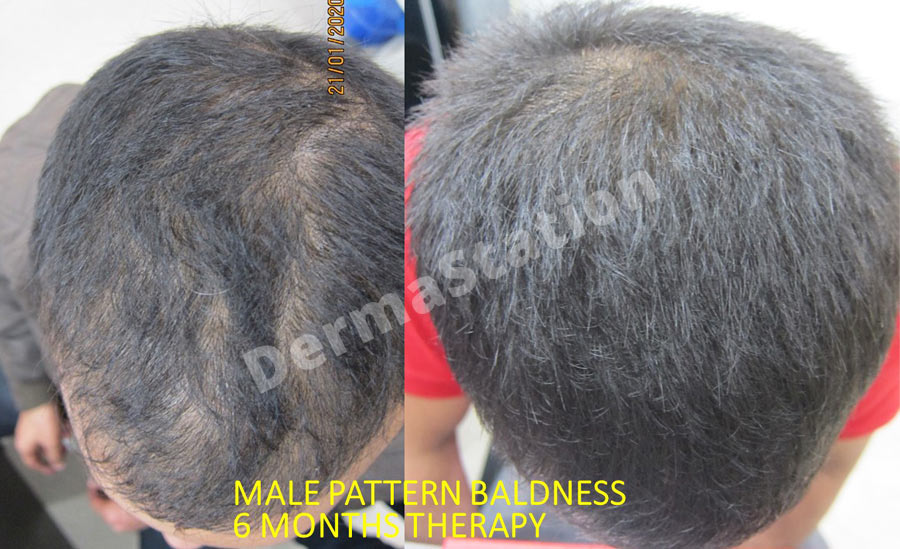 Hair Loss Treatment Delhi