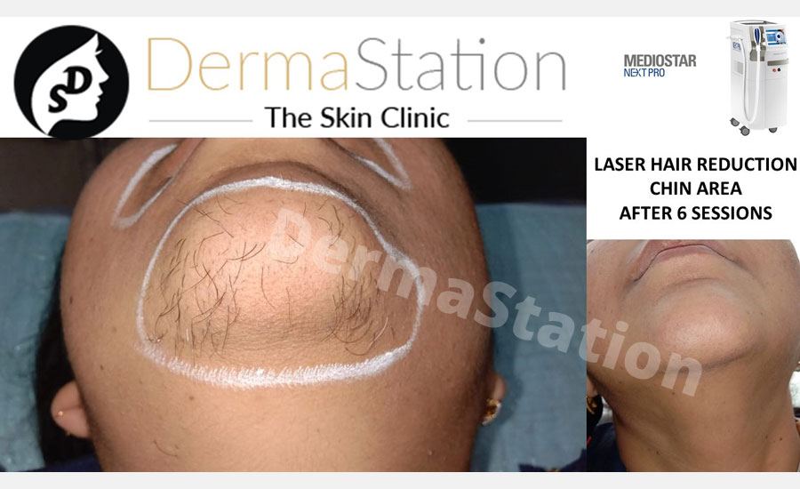 Laser Hair Reduction in Delhi