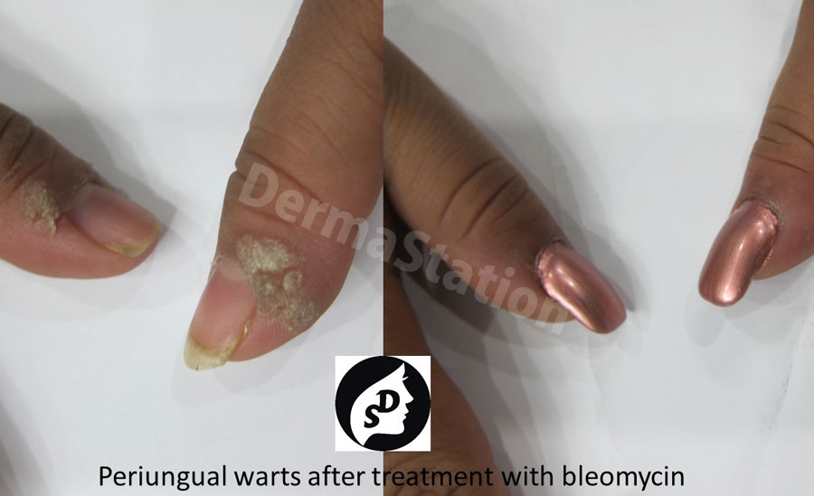 Periungual Warts after treatment with Bleomycin