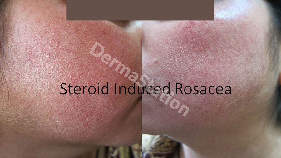 Rosacea skin disease