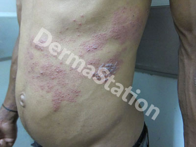 Herpes Zoster (shingles)