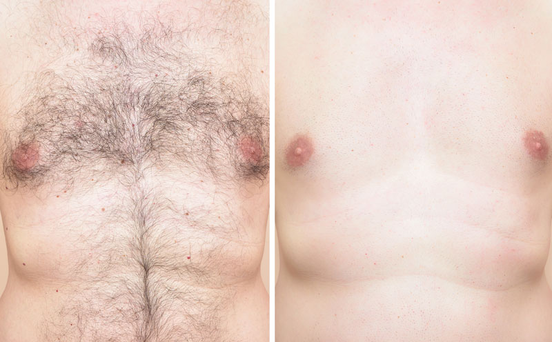 Laser Hair Reduction in Delhi Laser Hair Reduction in Delhi
