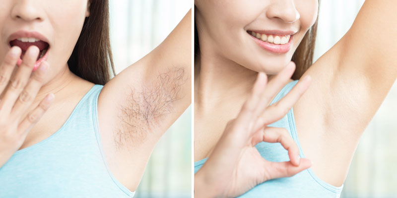 Laser Hair Reduction in Delhi Laser Hair Reduction in Delhi