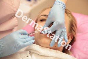 LIP FILLER