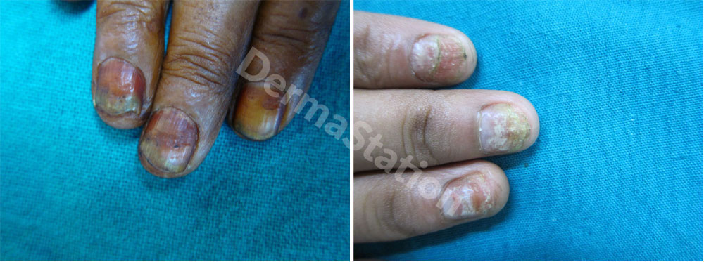 Nail Diseases Treatment