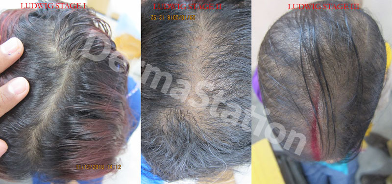 dermatologist in jankapuri, Hair Loss Treatment jankapuri