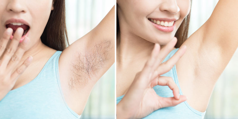 Laser hair removal in dwarka, Laser hair removal in Janakpuri