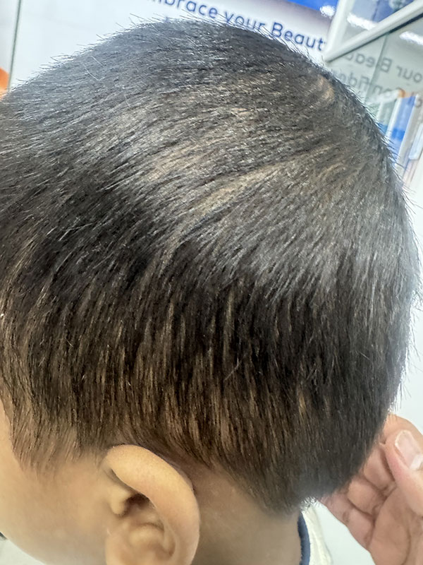 Alopecia Totalis
