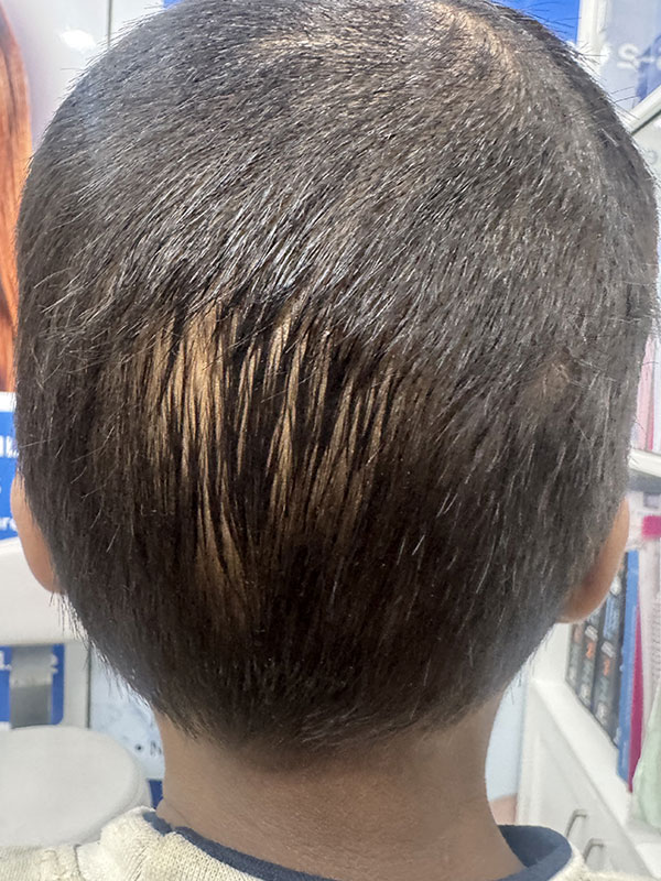 Alopecia Totalis
