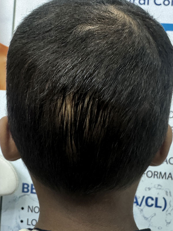 Alopecia Totalis
