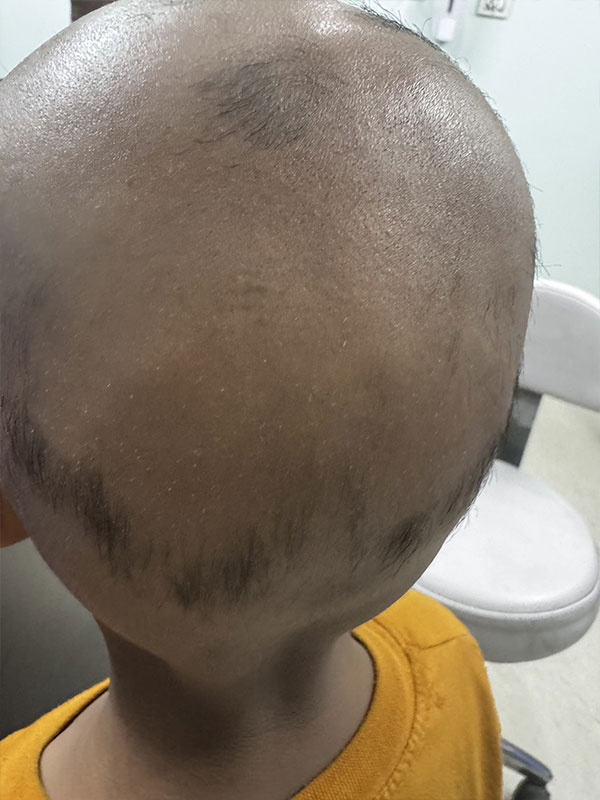 Alopecia Totalis