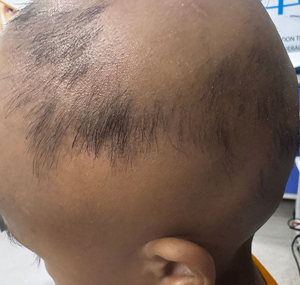 Alopecia Totalis