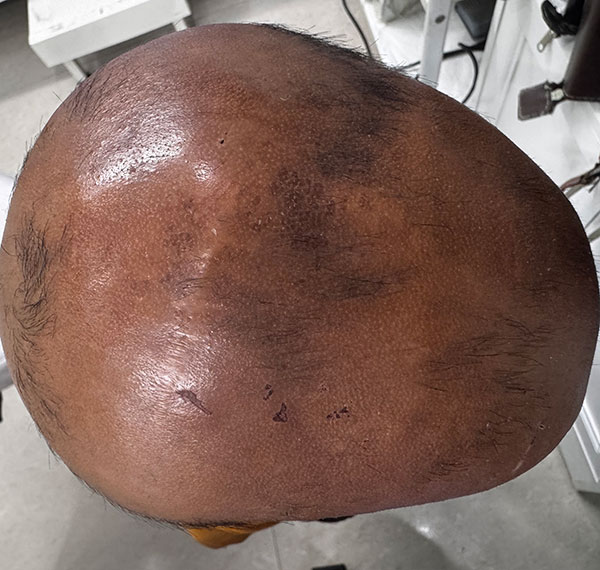 Alopecia Totalis